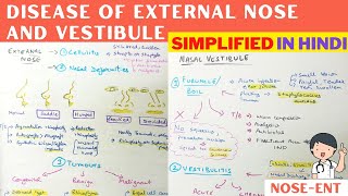 Disease of External nose and nasal vestibule  Hindi  ENT [upl. by Dorie167]