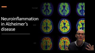 Neuroinflammation in Alzheimers Disease The Role of Microglia [upl. by Meisel]