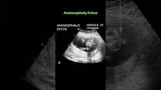 Anencephaly Fetus [upl. by Hakeem]