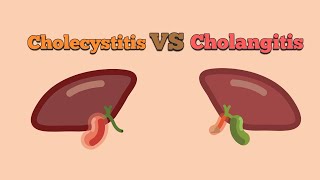 Difference between Cholangitis and Cholecytitis [upl. by Timofei]