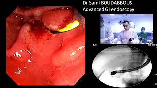 ERCP FOR BILIARY FISTULA AFTER LAPAROSCOPIC CHOLECYSTECTOMY [upl. by Amsab]