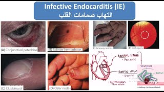 Infective Endocarditis إلتهاب صمامات القلب [upl. by Ahcim]