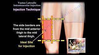 Vastus Lateralis Intramuscular Injection  Everything You Need To Know  Dr Nabil Ebraheim [upl. by Ydoc]