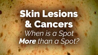 When is a Spot More than a Spot Skin Lesions and Cancers [upl. by Seiden]