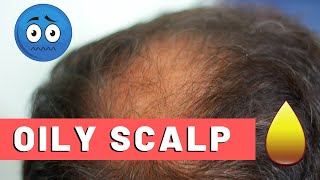 Oily Scalp Treatment For Hair Loss The Best Way [upl. by Latsirc]