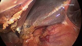 Laparoscopic cholecystectomy [upl. by Mindi]