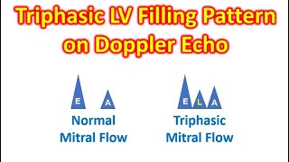 Triphasic LV Filling Pattern on Doppler Echo [upl. by Tteraj669]