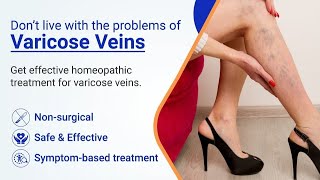 Vericose Veins Treatment  Scelero Therapy vericose veins yt treanding viralvideo [upl. by Soule]