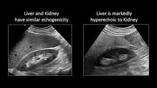 GI Imaging  Hepatic Steatosis and Cirrhosis [upl. by Stanfield]