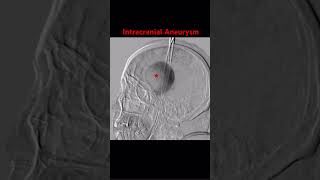 Intracranial Aneurysm radiology brain neurology [upl. by Grinnell]