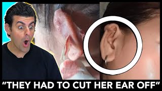 Ear Piercing Infected So BAD They Had To Amputate It [upl. by Maison]