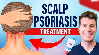 Doctor explains FOUR TREATMENTS for SCALP PSORIASIS [upl. by Anauqahc]