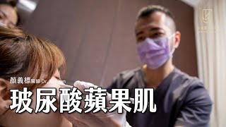 【微整形美學】玻尿酸注射－蘋果肌｜DrKeegan 顏義標醫師｜金貞醫學美容 [upl. by Gasperoni70]