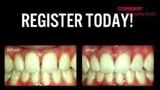 Diastema Closure Webinar preview [upl. by Nohsram]