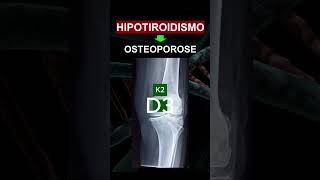 HIPOTIROIDISMO  OSTEOPOROSE [upl. by Nilat44]