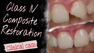 Class IV Composite Restoration Clinical case [upl. by Omura]