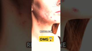 Mukha ma kalo dag pimple chha vane 10 din ma hataunu hos yasri😱trending amazing video subscribe [upl. by Llydnek411]