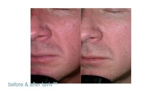 FDAApproved LaViv Fibroblast Treatment  Maryland Laser Skin amp Vein [upl. by Assela]