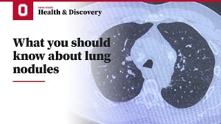 What you should know about lung nodules  Ohio State Medical Center [upl. by Anerdna451]