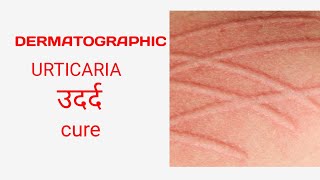 Dermatographic urticaria treatment urticaria ayurveda [upl. by Georglana]