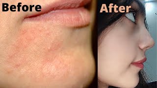 How i got rid of my Perioral Dermatitis and Steroidal acne on face  Get rid of Rosacea permanently [upl. by Neuburger]