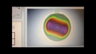 Advanced femto LASIK with custom elliptical flap for astigmatism correction wmv [upl. by Tibbetts]