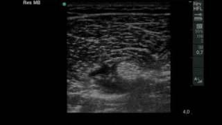 Ultrasound guided Infragluteal Sciatic Nerve Blockmov [upl. by Essila]