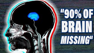 The Most Bizarre Medical Case in Neuroscience [upl. by Aidnic270]