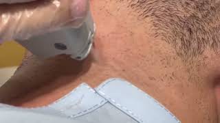 permanent Hair removal treatment hairremoval dermatology dermalab skincare gentlelase [upl. by Walden]