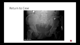 Damage Control Orthopedics Temporary Fixation of Pelvic Fracture Following Polytrauma [upl. by Hallimaj]