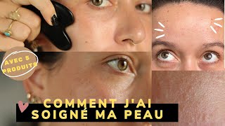 Comment jai soigné ma peau boutons acné microkystes avec 5 produits [upl. by Trip]