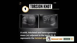 Scrotal Cancer UltrasoundTesticular UltrasoundUltrasound course [upl. by Tailor]