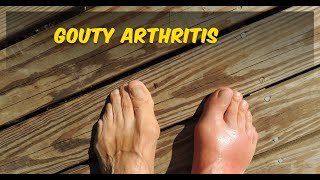 Gouty arthritis  joint pain [upl. by Nagem224]