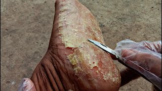 Ultimate Foot Scraping Transformation for an Australian Man [upl. by Nozicka513]