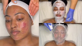 CYSTIC ACNE TREATMENT  WALKIN FACIAL FOR GRADE 3 AND 4 ACNE WITH PRO TIPS  LICENSED ESTHETICIAN [upl. by Cline90]