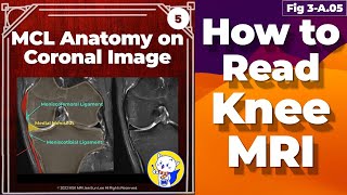 Fig 3A05 Medial Collateral Ligament Anatomy Knee MRI coronal and axial images [upl. by Ik]