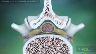 Osteophytes bone spurs Definition [upl. by Eibbor]