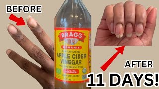 I Tried APPLE CIDER VINEGAR for Dyshidrotic Eczema and THIS happened in 11 Days [upl. by Amaso]