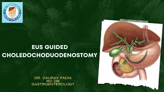 Endoscopic Ultrasound Guided Choledochoduodenostomy  PeriAmpullary Carcinoma  EUSBD [upl. by Iridis]