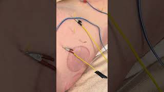 Hip Pain treated with Dry Needling Electrical Stim and Acupuncture in a Marathon Runner [upl. by Assirehc]