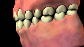 Gingival Hyperplasia [upl. by Naitirb]