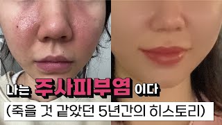 4년간의 지긋지긋한 주사피부염 완치 기록  안면 홍조 관리 [upl. by Prue]