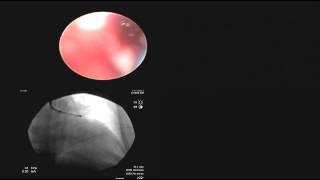 Pulmonary case with Bronchoscope and CArm in a MedicVOD system [upl. by Mak157]