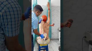 Severe idiopathic scoliosis treatment by DrRavi scoliosis chiropractor trend spine chiropractic [upl. by Alenoel229]