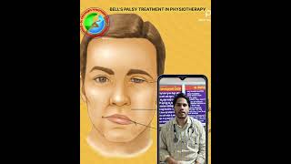 bells palsy physiotherapy shorts youtubeshorts viralshort video paralysis facebook [upl. by Anirb]