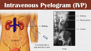 Intravenous pyelogram IVP [upl. by Leunamne]