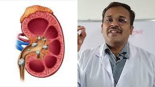 Kidney Stone Removal  Kidney Stone Causes Signs and Treatment Methods [upl. by Inness]