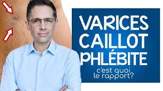 Varices caillot et phlébite cest quoi le rapport [upl. by Ennaj]