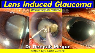 Phacomorphic Lens Induced Glaucoma  Phacoemulsification ChallengesDr Deepak Megur [upl. by Eisak]