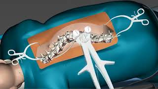 Spinal Curvature Surgery 3D [upl. by Anabahs]